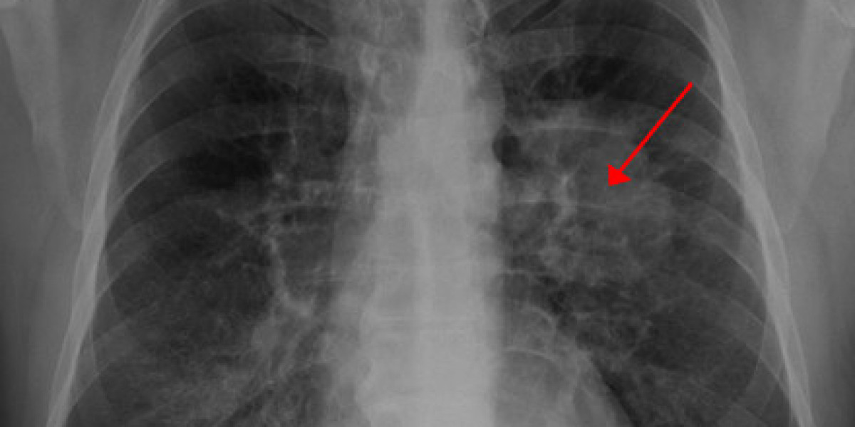 Bronchial Tumors