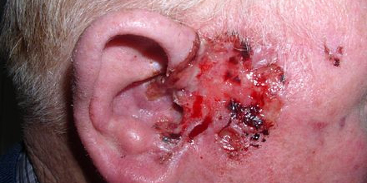 Basal Cell Carcinoma (BCC)