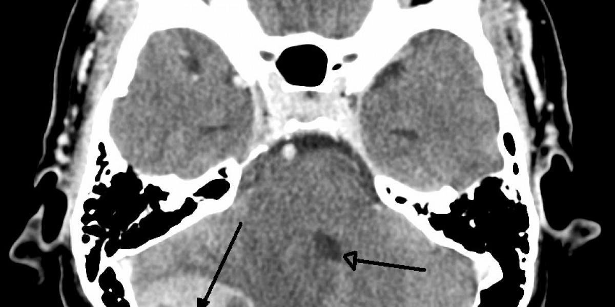 Brain Tumors