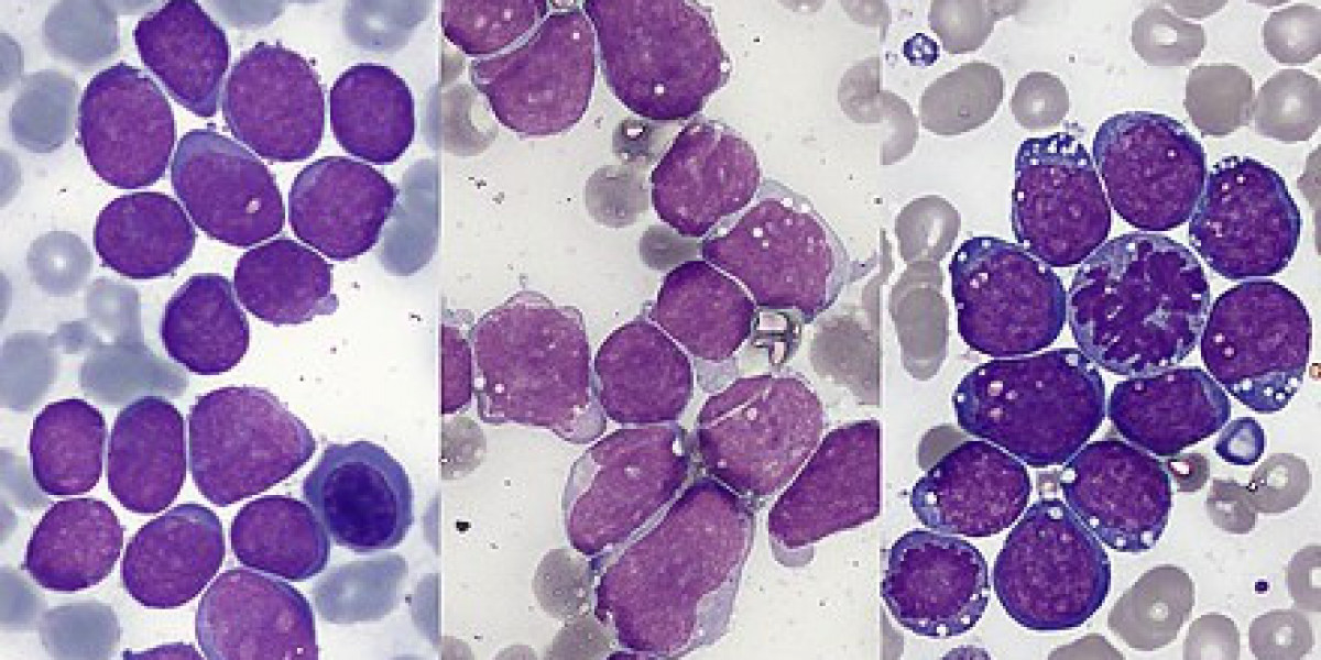 Acute Lymphocytic Leukemia (ALL)