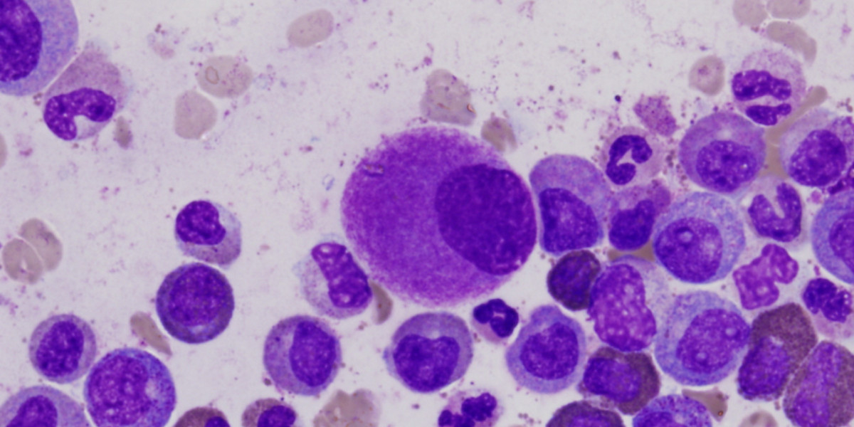 Chronic Myelogenous Leukemia (CML)