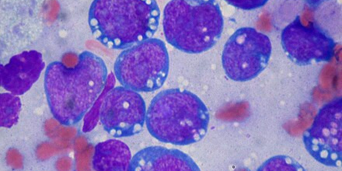 Burkitt Lymphoma