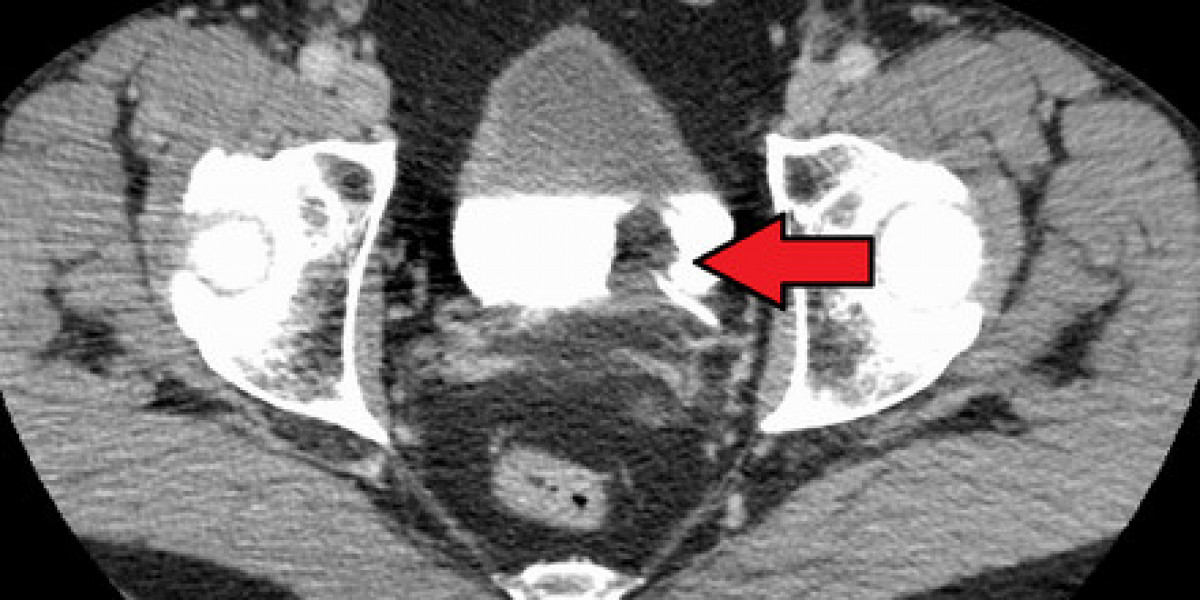 Bladder Cancer