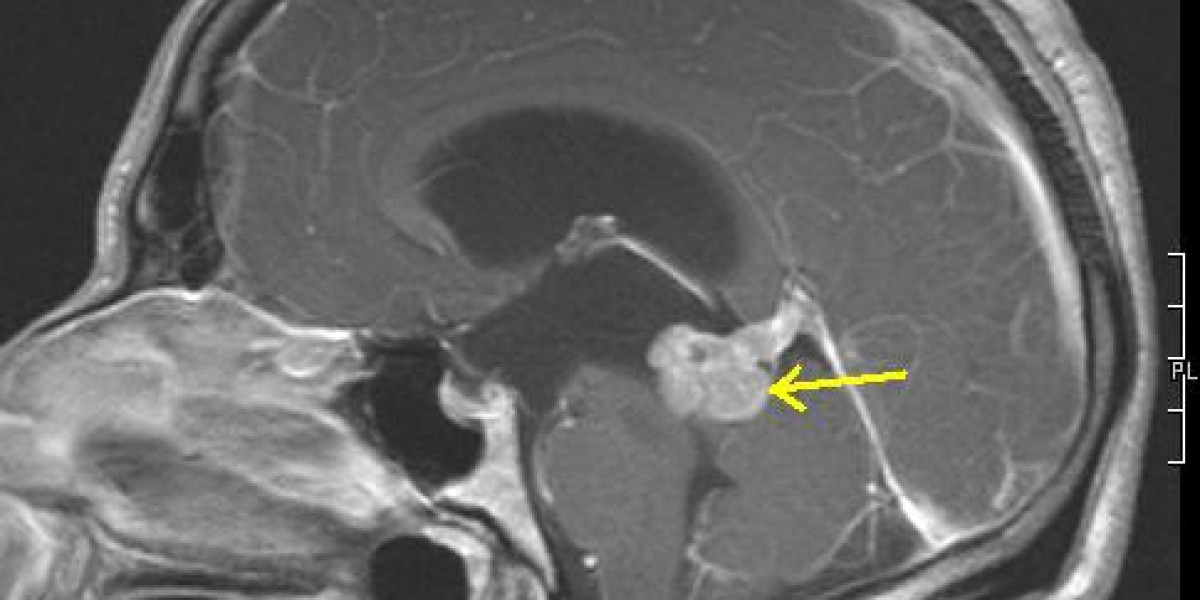 Astrocytoma