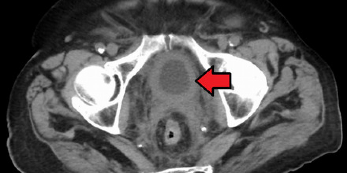 Bladder Cancer