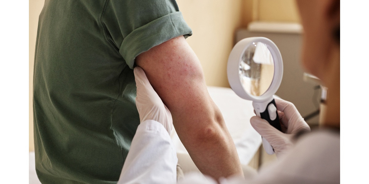 Alleviating Skin Side Effects in Colorectal Cancer