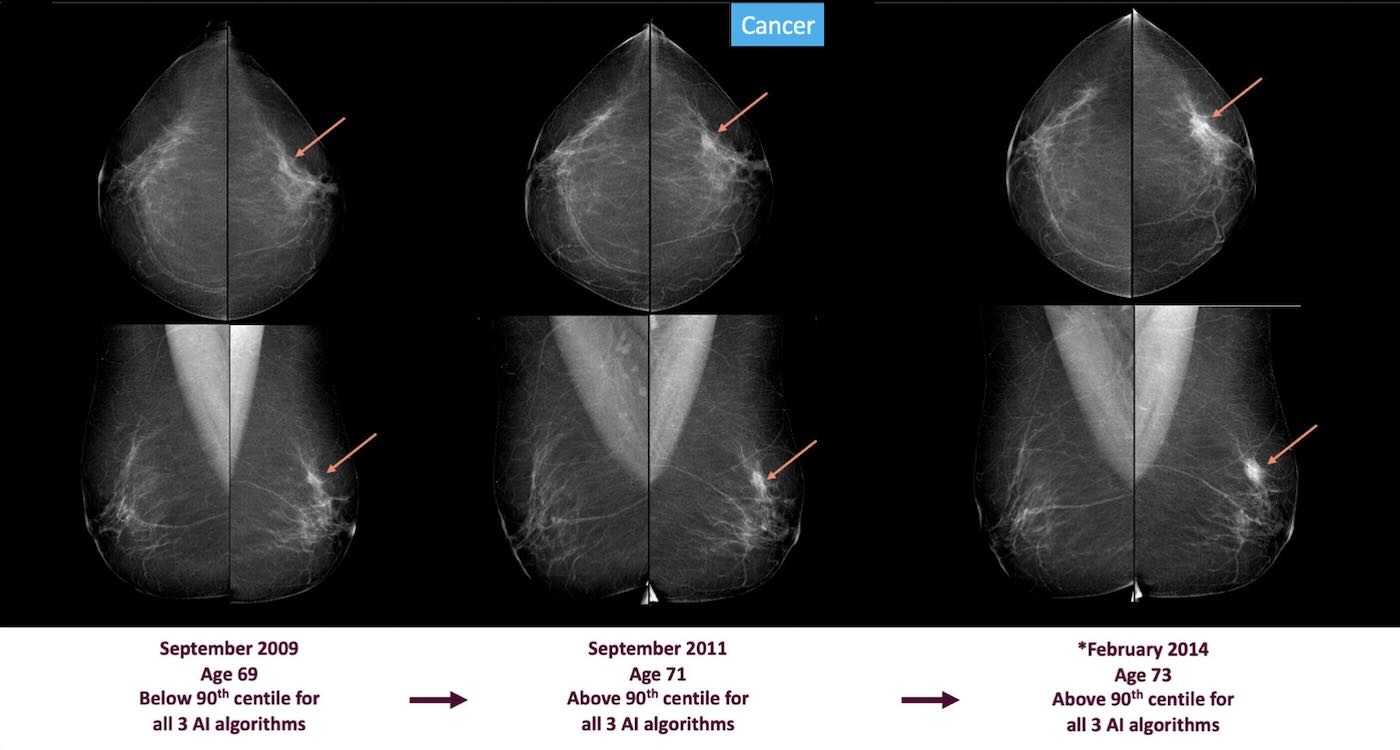 AI detects breast cancer signs up to 6 years early